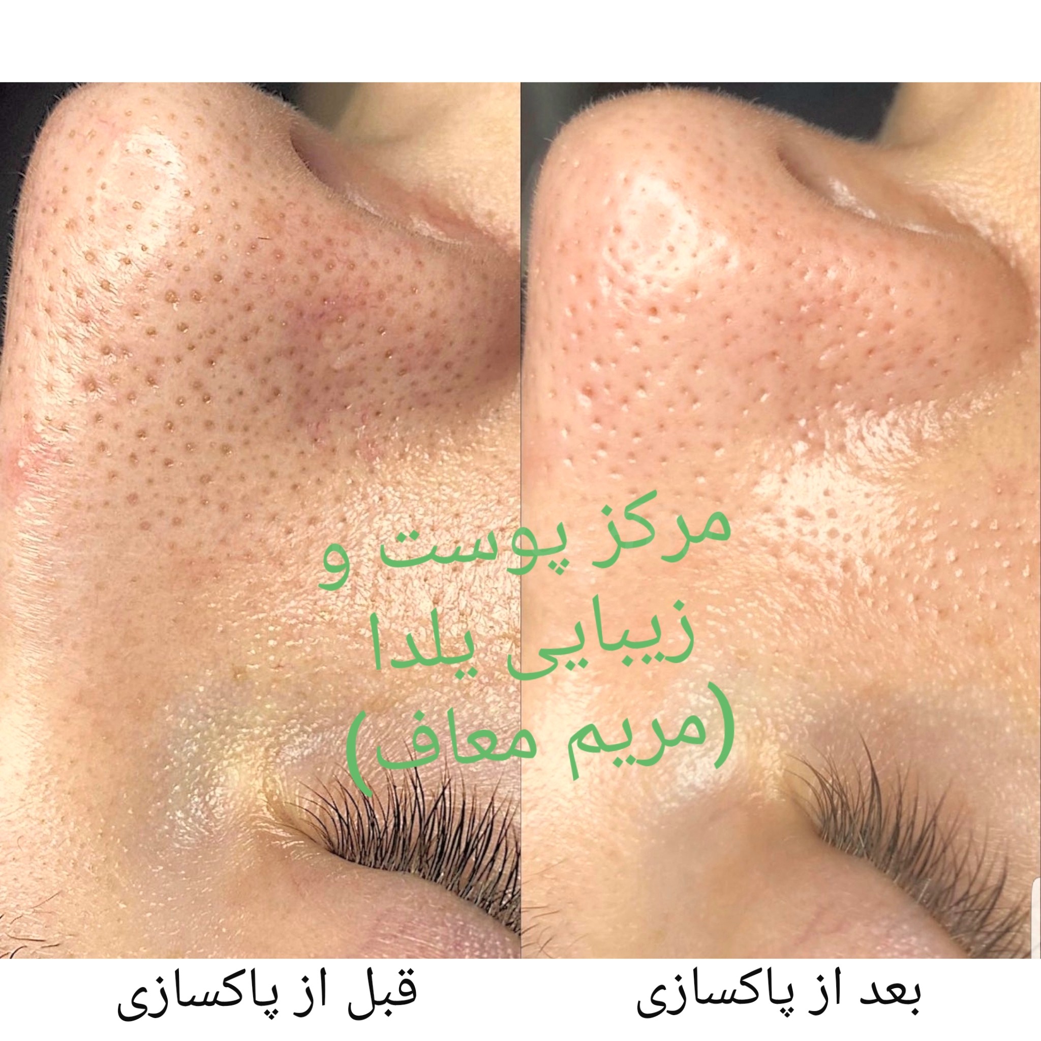 پاکسازی پوست