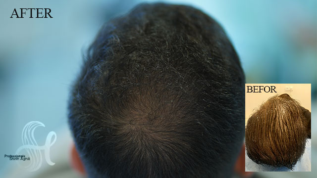 How To: Meso Needling For Hair Loss