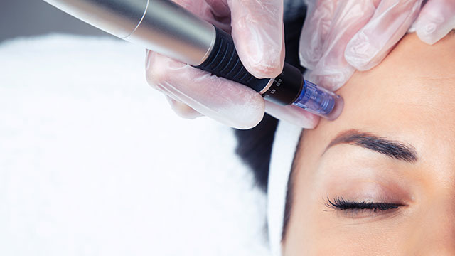 How To: What Is Microneedling? Facts And FAQs