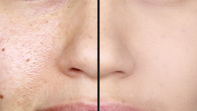 How To: Pimple Spot Herbal Treatment